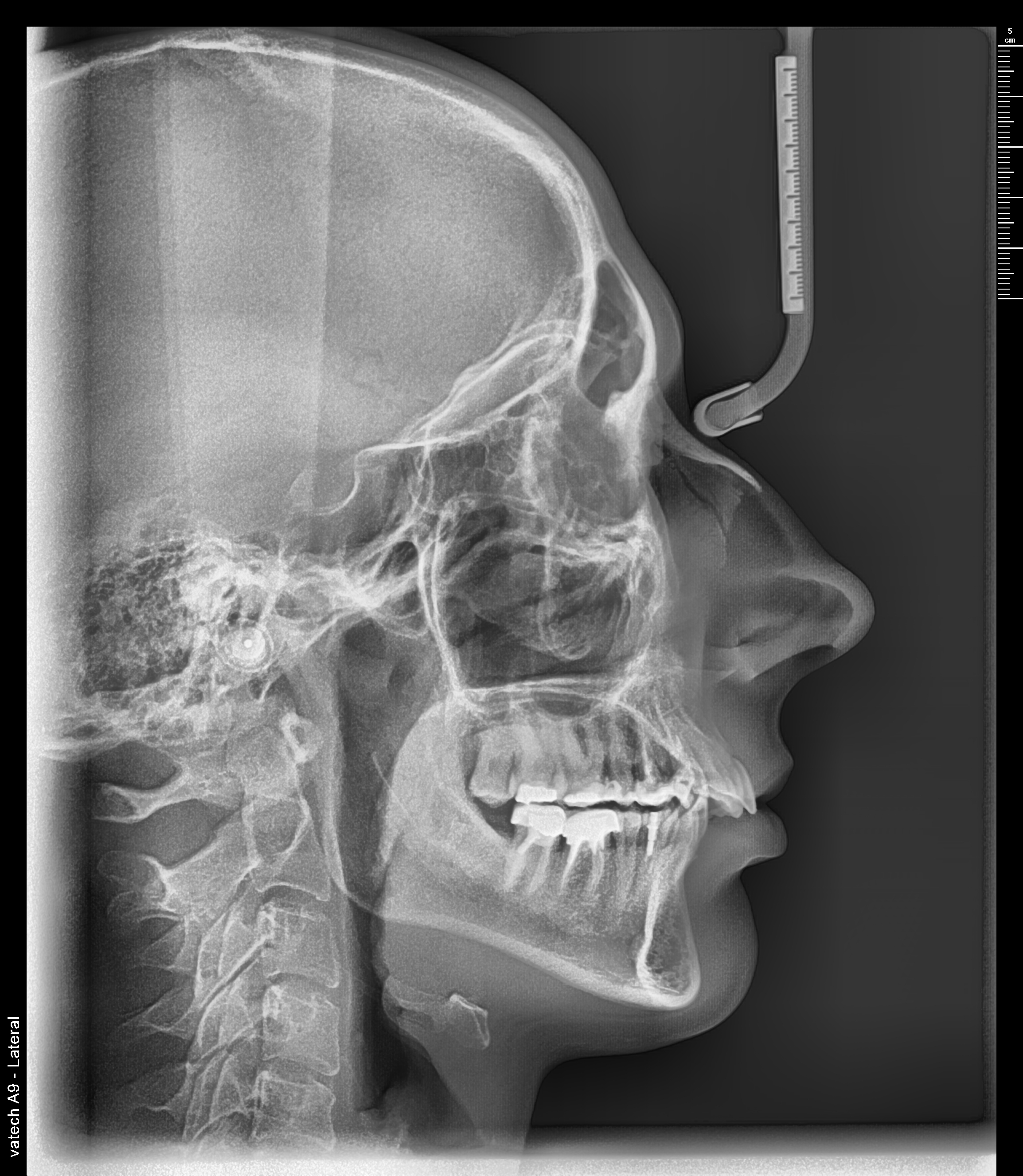 Телеренгтгенография